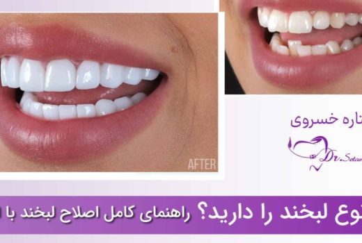 راهنمای کامل اصلاح لبخند با ارتودنسی