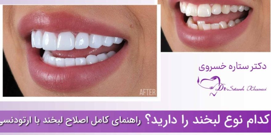 راهنمای کامل اصلاح لبخند با ارتودنسی
