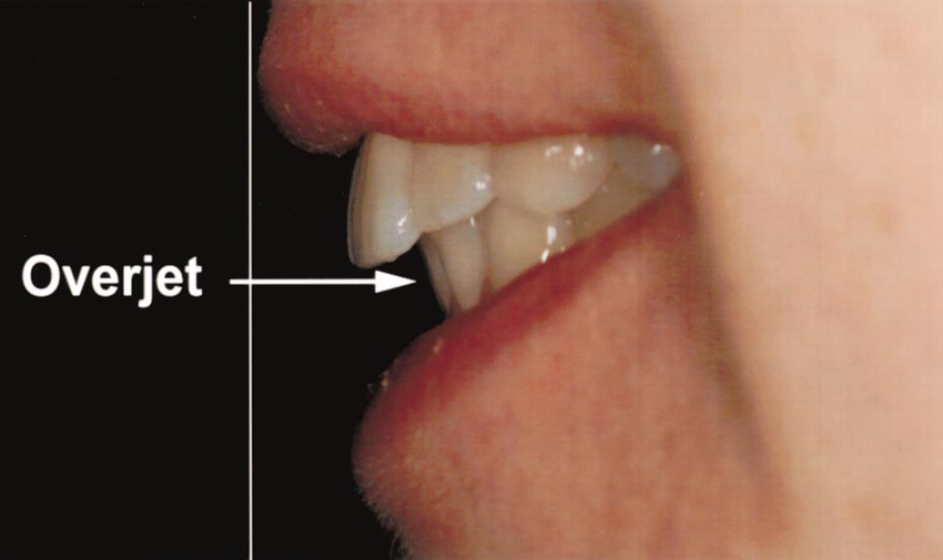 لبخند با جلوآمدگی دندان‌ها (Overjet Smile)